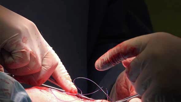 Surgical Suture Or Stitches 12