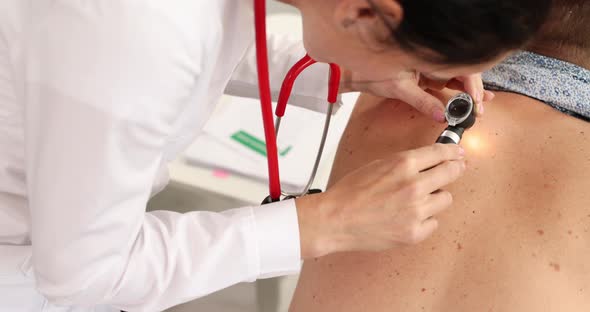Doctor Dermatologist Oncologist Examines Moles Through Magnifying Glass on Patient Back