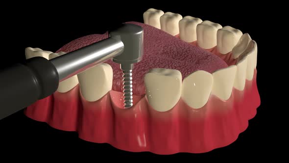 Dental Implant Procedure