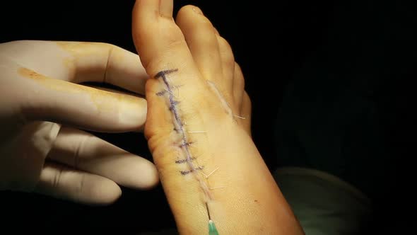 Foot Surgery