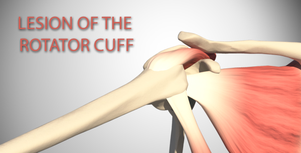 Lesion Of The Rotator Cuff alt