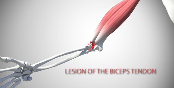 Lesion Of The Biceps Tendon alt