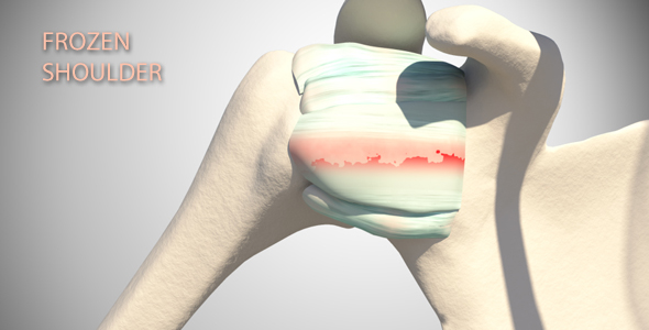 Frozen Shoulder alt