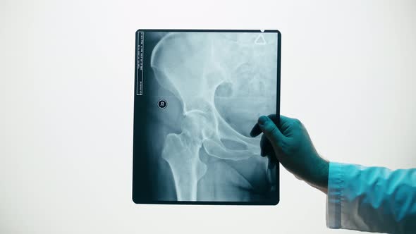 Pelvic Hip Xray Closeup