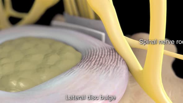 spinal cord - lateral disc bulge