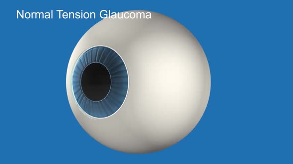 3D Medical Animated Normal Tension Glaucoma on Blue Background