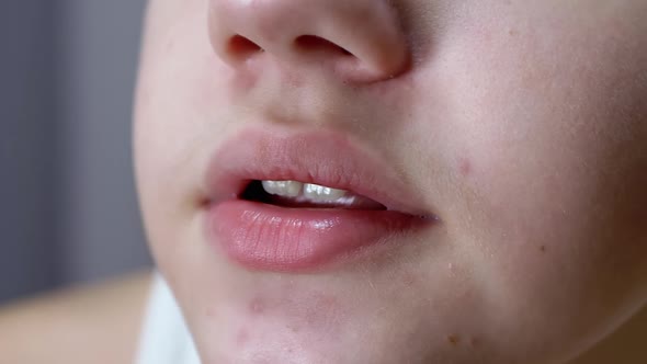 Closeup of Face Lips and Mouth of a Talking Teenager with Acne on the Skin