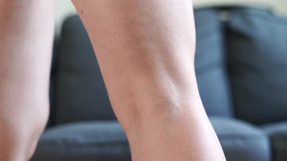 Woman's Leg with Varicose Veins. Treatment with Cream. 