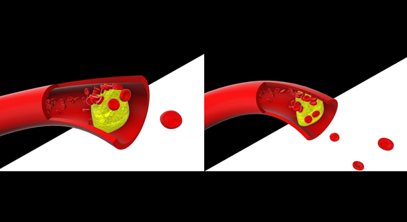 Cholesterol Blocked Blood Vessel