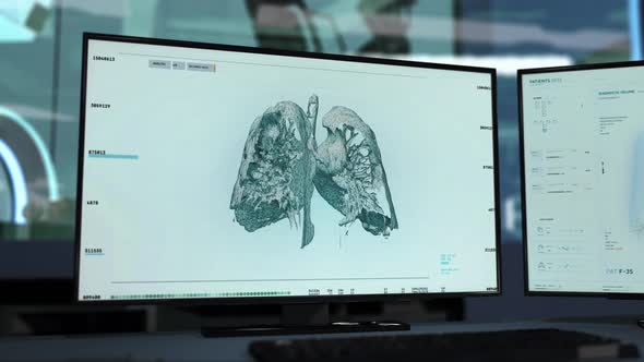 Modern laboratory system has detected cancer cells in the lungs of the patient alt