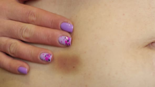 Close-up of a Large Bruise or Bruise on the Skin of the Abdomen of a Woman.