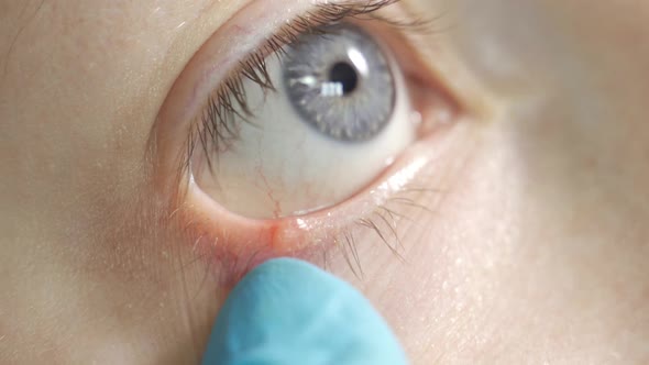 Blepharitis of Eyes and Eyelashes Closeupallocation of Meibomian Glands