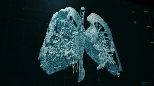 Medical tomography scanning lungs affected by pneumonia caused by coronavirus.