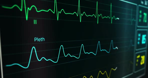 ECG Cardiac heart rate monitor in hospital loopable