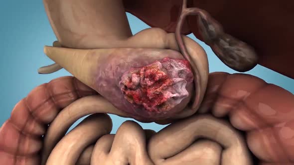 pancreatic cancer  medical animation