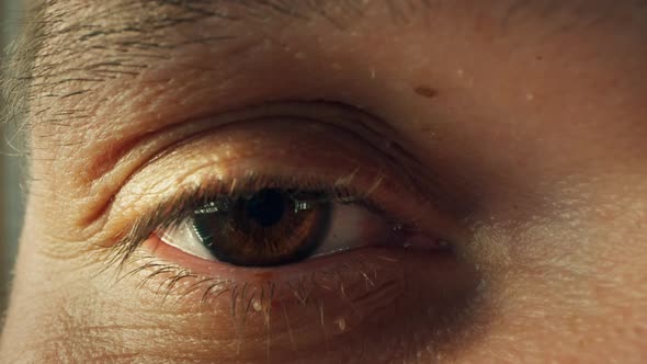 Macro Shot of Man's Eye with Fibroma