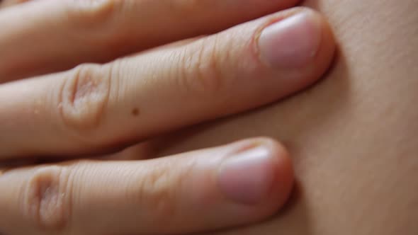 Moles On Body Dermatology