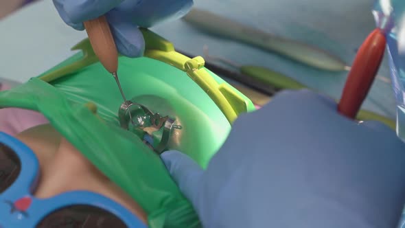 Dentist Uses Cofferdam for Treatment Caries and Tooth Reconstruction of a Child