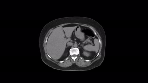 Purified MRI of the Abdomen, Gastrointestinal Tract, Bladder