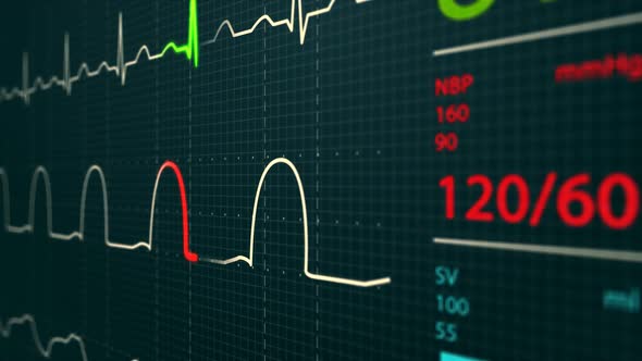 Animation of Intensive Care Unit monitor showing normal values for vital signs.