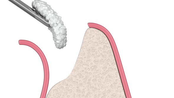 Dental bone grafting as preparation for dental implant installation