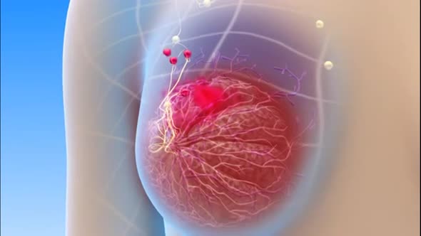 Girl with breast pathology.female human structure.Breast cancer