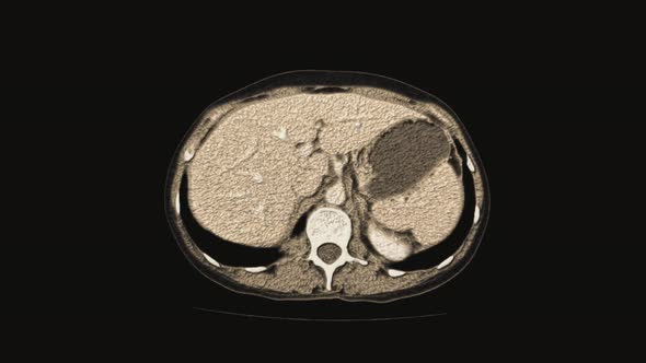 Voluminous Color MRI of the Female Pelvic Organs Abdominal Cavity Gastrointestinal Tract and Bladder