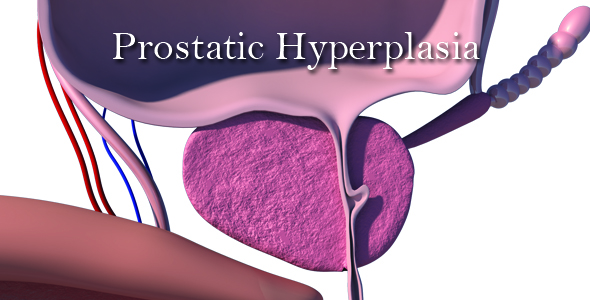 Prostatic Hyperplasia