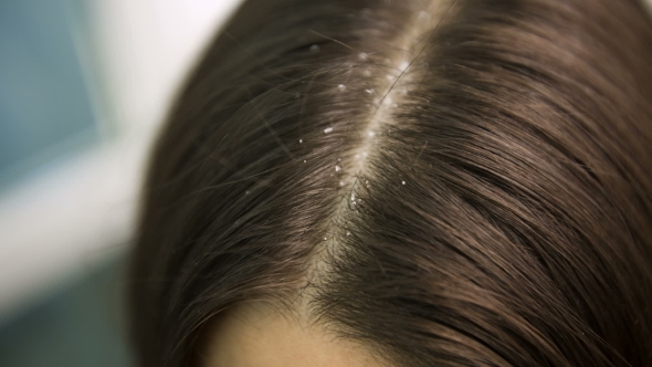 Dandruff Disappear From Woman's Hair