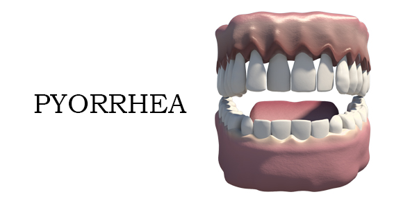 Pyorrhea