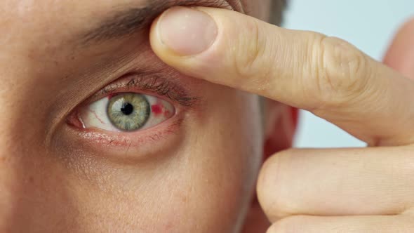 Closeup of a Man's Sore Eye Spread Wide with Fingers