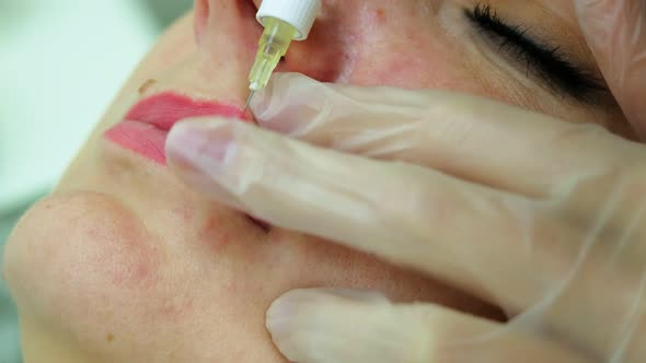 The Cosmetologist Makes Injections on the Client's Face in the Lip Area