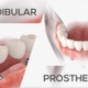 Mandibular Prosthesis 6 Implants - VideoHive Item for Sale