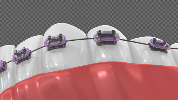 Teeth With Braces Or Brackets alt