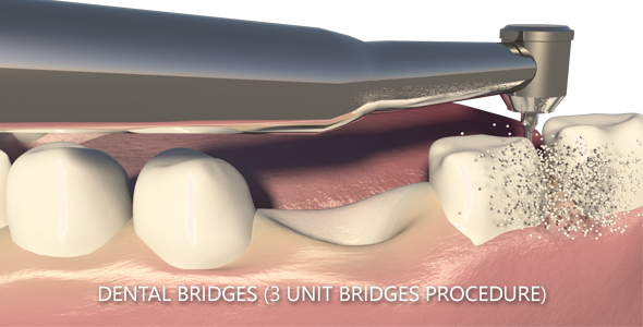 Dental Bridges (3 Unit Bridges Procedure)