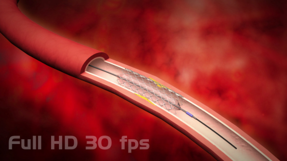 Angioplasty and stenting