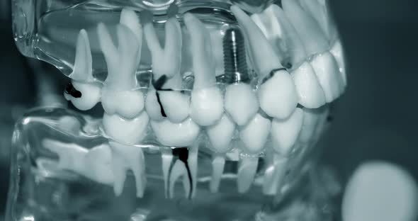 Transparent Model of Human Teeth with Implants Closeup