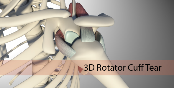 3D Rotator Cuff Tear