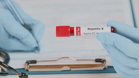 The Doctor Holds Hand Blood Sample Positive with Hepatitis B Virus