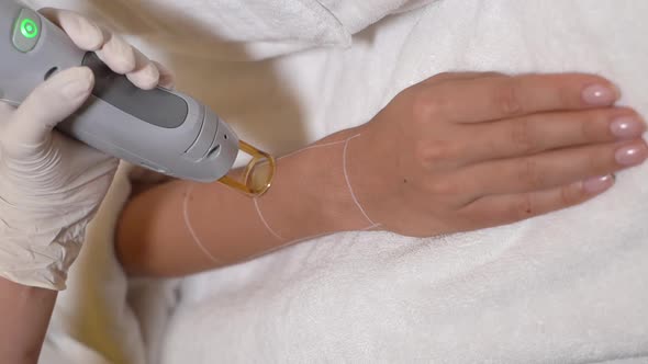 Laser Hair Removal