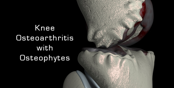 Knee Osteoarthritis With Osteophytes