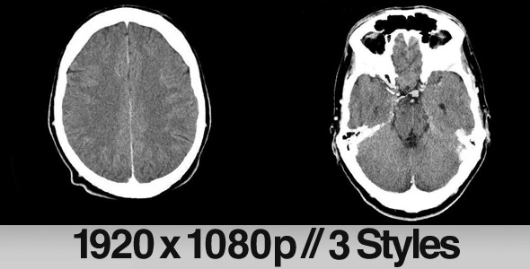 CT CAT Scan Of Brain 3 Styles