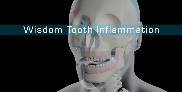 Wisdom Tooth Inflammation