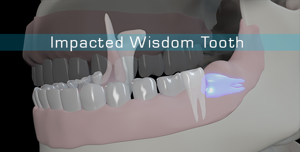 Impacted Wisdom Tooth