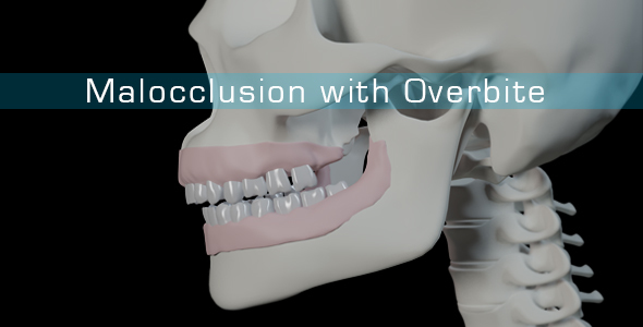 Malocclusion With Overbite