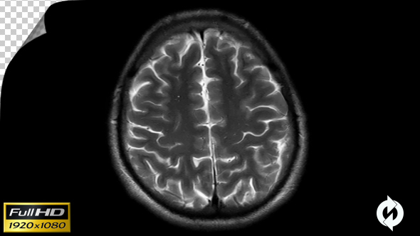 Human Brain MRI Scan - Alpha Channel alt
