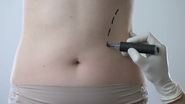 Surgeon Drawing Marks on Abdomen, Preparing Woman for Liposuction Surgery