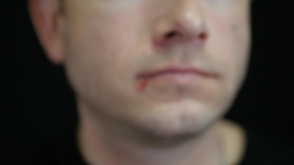 A Man Touches the Ulcer on His Lips Against a Black Background. Herpes