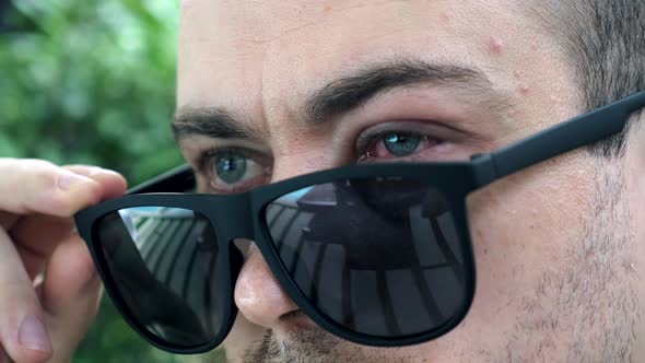 Man with Allergies Wears Dark Sunglasses Hiding Injured Eye After Insect Bite