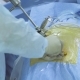 Hands of a Surgeon Inserting Instrument - VideoHive Item for Sale